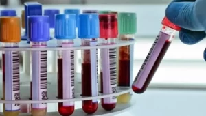 آزمایش Anti-ds.DNA