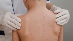 تشخیص و علائم لیستریا