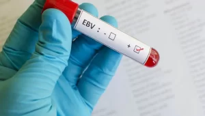 آزمایش EBV