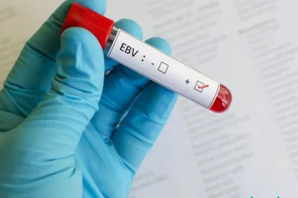 آزمایش EBV