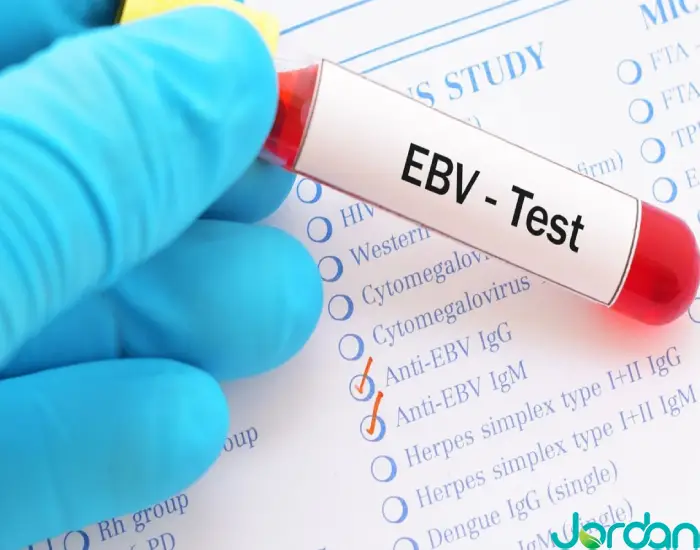 آزمایش EBV