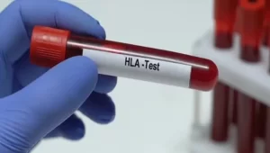 آزمایش آنتی ژن لکوسیت انسانی (HLA)