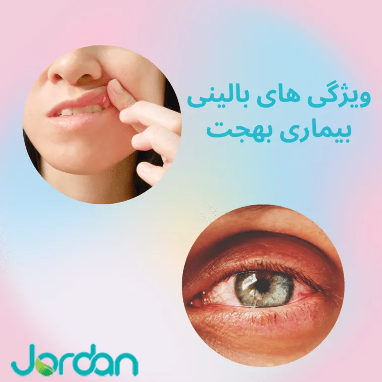 ویژگی های بیماری بهجت