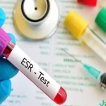 آزمایش ESR