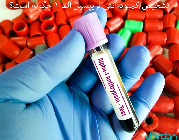 نقص آنتی تریپسین آلفا 1