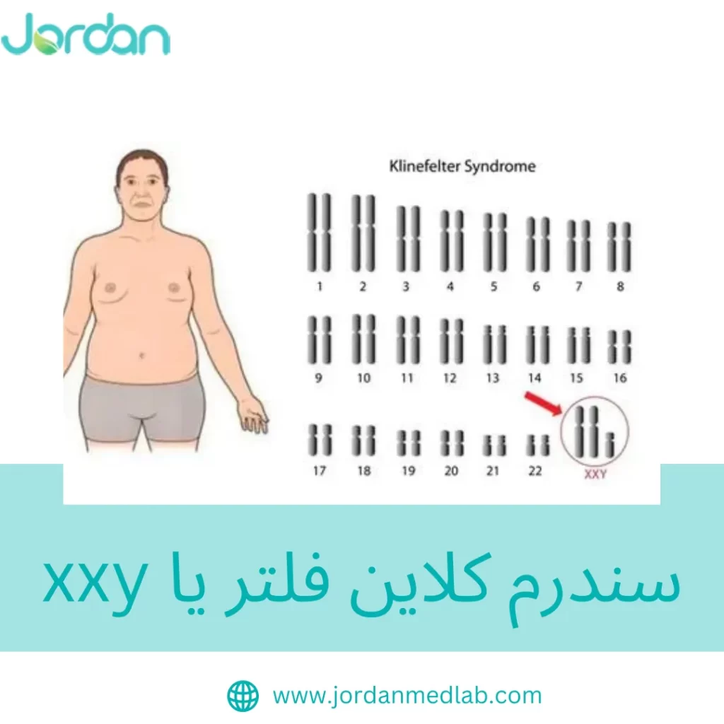 سندرم کلاین فلتر یا xxy