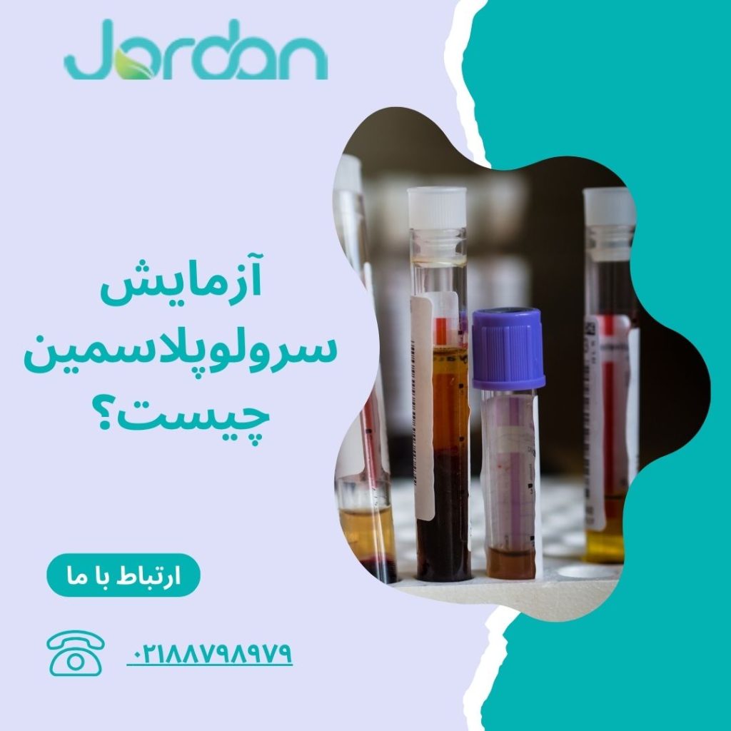آزمایش سرولوپلاسمین