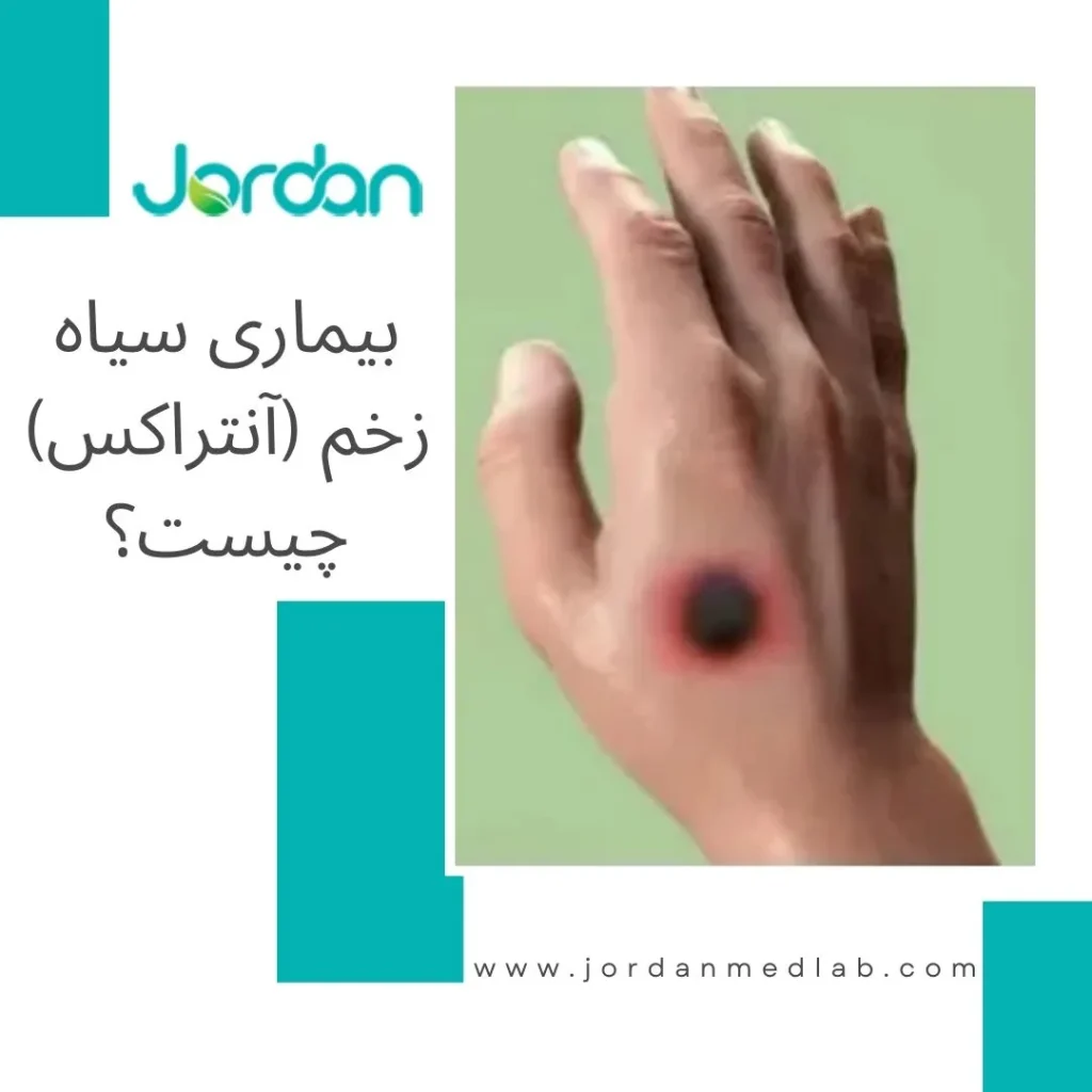 بیماری سیاه زخم