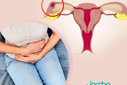 بارداری خارج رحمی