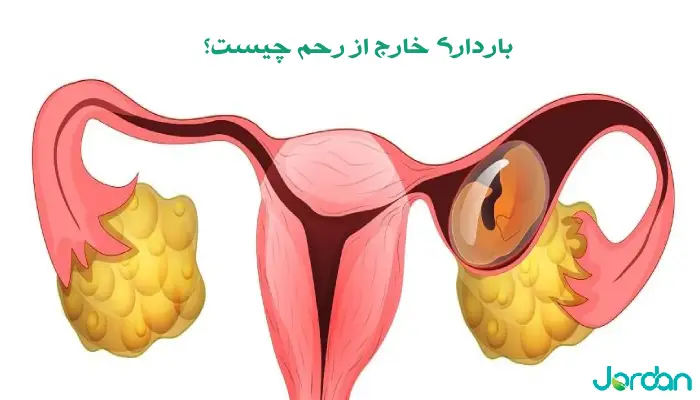 بارداری خارج رحمی