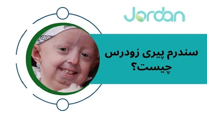 سندرم پیری زودرس