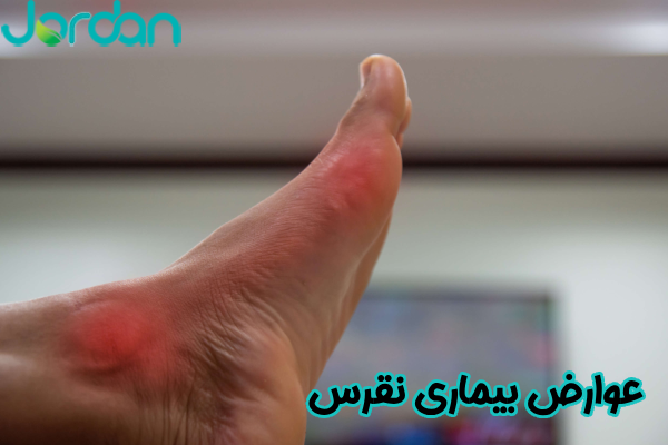 عوارض بیماری نقرس