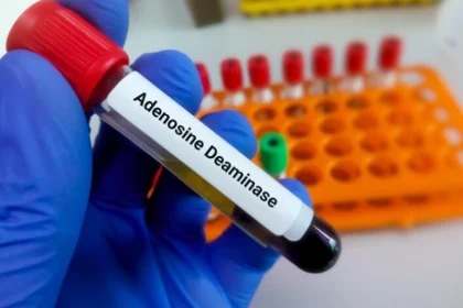 Adenosine-deaminase-test آزمایش آدنوزین دآمیناز