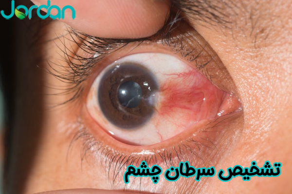 تشخیص سرطان چشم