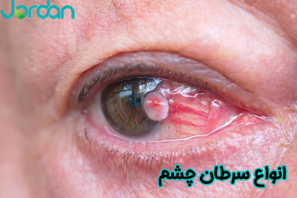 انواع سرطان چشم