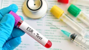 ESR-test آزمایش ESR