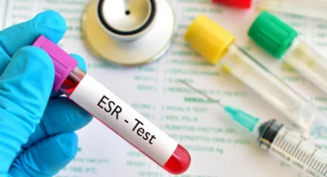 آزمایش ESR
