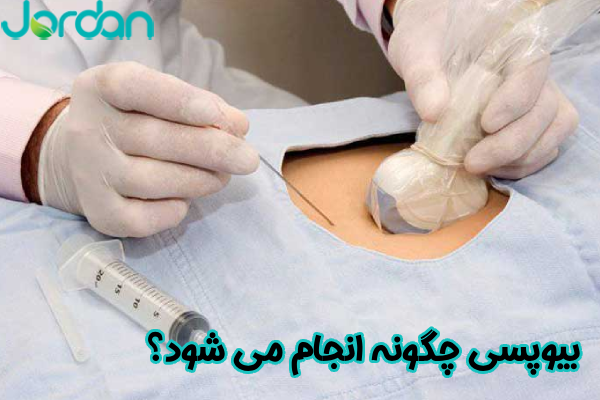 بیوپسی چگونه انجام می‌ شود؟
