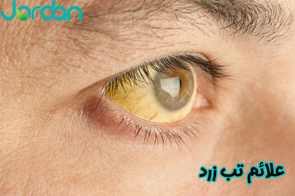 علائم تب زرد