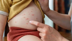 ماستوسیتوز