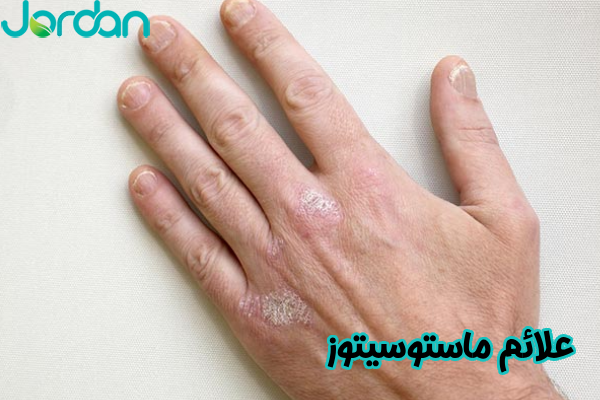 علائم ماستوسیتوز