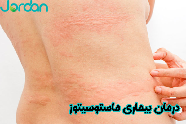 درمان بیماری ماستوسیتوز