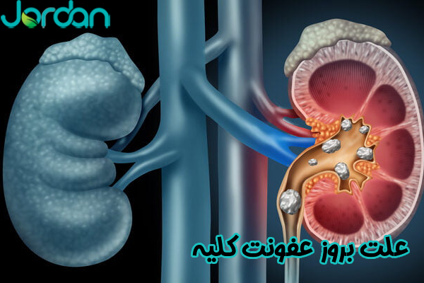 علت بروز عفونت کلیه