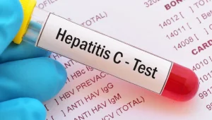 Hepatitis-C-test آزمایش هپاتیت C