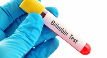 Bilirubin test آزمایش بیلی روبین